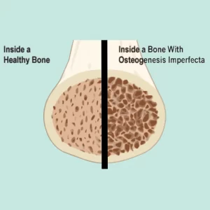 Osteogenesis Imprefecta diagram